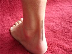 Achilles Tendonitis