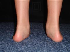 'Foot Pronation'/